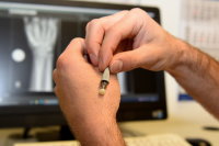 Arthrose im Daumen: Expertinnen und Experten der Handchirurgie am Bergmannsheil raten bei dieser Diagnose zur Daumenendoprothese. Bildnachweis: BG Universitätsklinikum Bergmannsheil